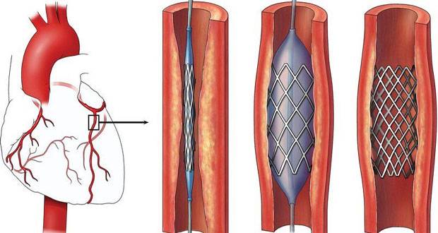 NUST first in Pakistan to produce cardiac stents