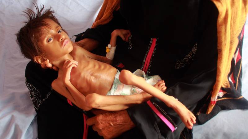 Yemen's starving children, grim legacy of six years of war