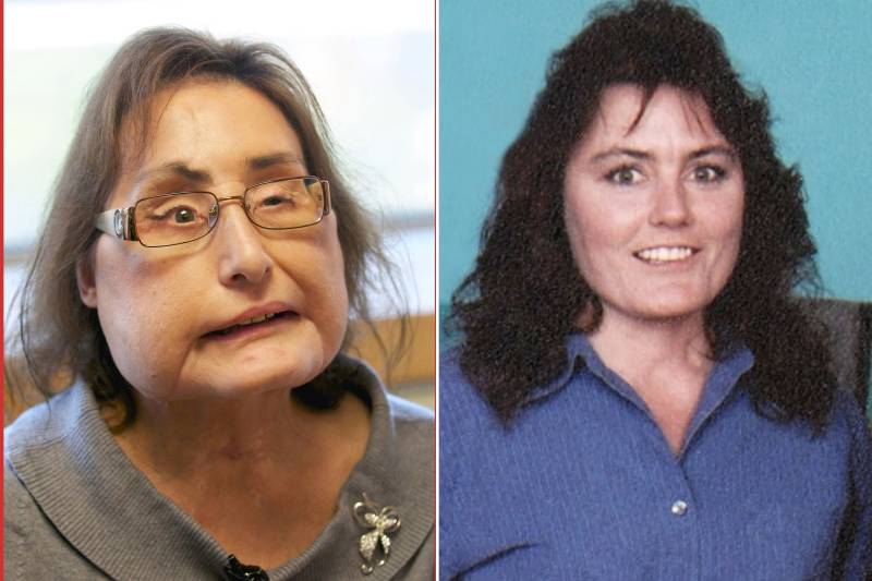 First US woman who received a partial face transplant dies at 57