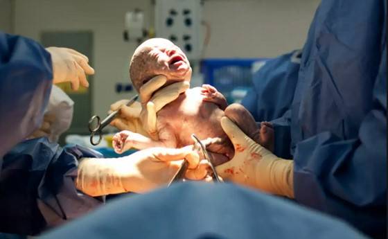 First baby born after uterus transplant in France