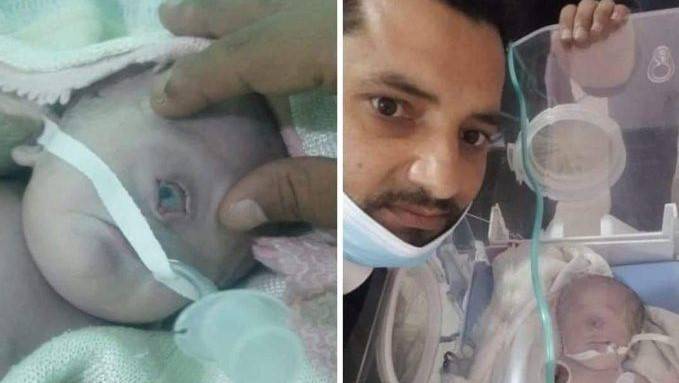 Yemeni baby with one-eye dies 7 hours later