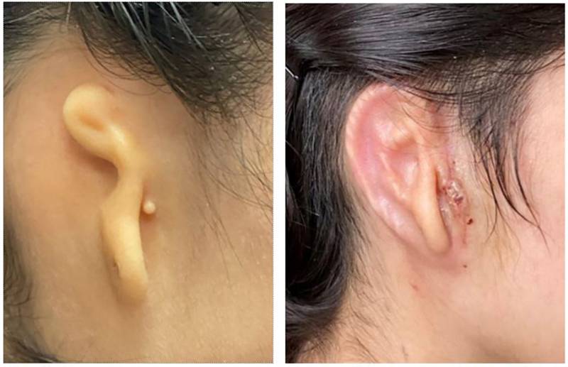 Surgeons transplant 3D ear made of living cells