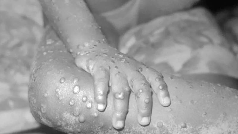 WHO issues snapshot of monkeypox cases