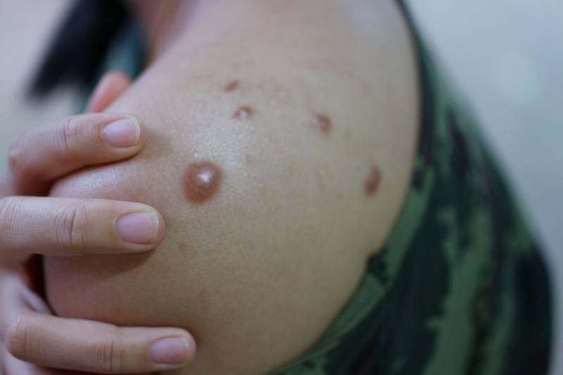 95% of monkeypox cases transmitted through sexual activity, finds study