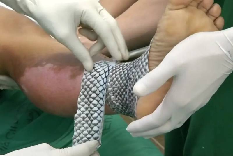 Dressing 'revolution' seeks artificial skin for burn victims