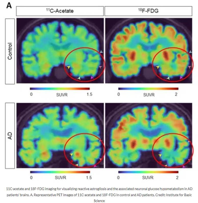 A new breakthrough in Alzheimer disease research