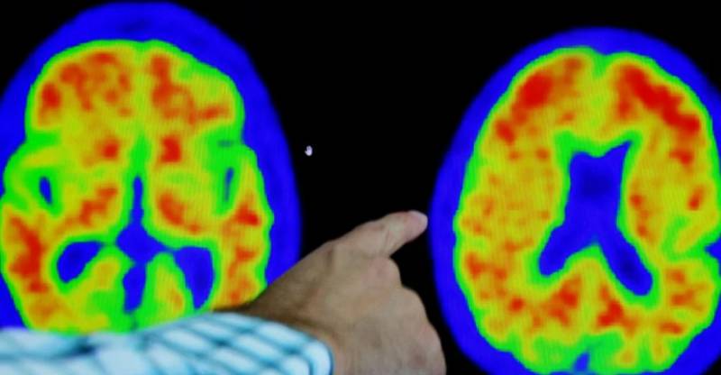 'Remarkable' Alzheimer drug reduces cognitive decline, results show