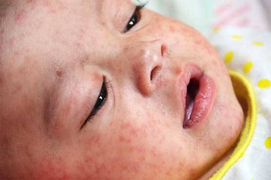 Two minor girls die of measles in Kandhkot