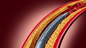 Govt notifies huge increase in cardiac stents prices 