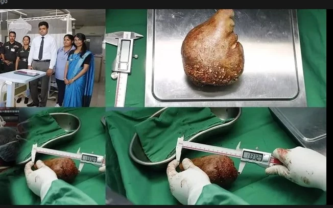 Sri Lanka doctors remove 'world's largest kidney stone'