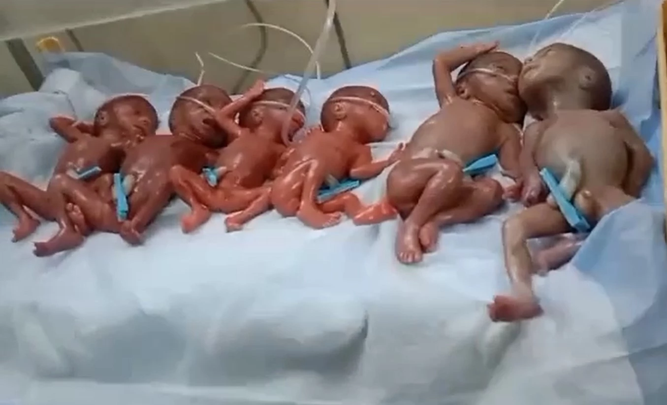 Woman gives birth to sextuplets in Hyderabad, five die