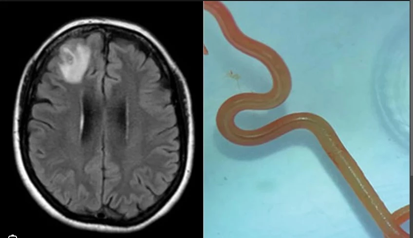 Australian doctors find live parasitic worm in woman's brain