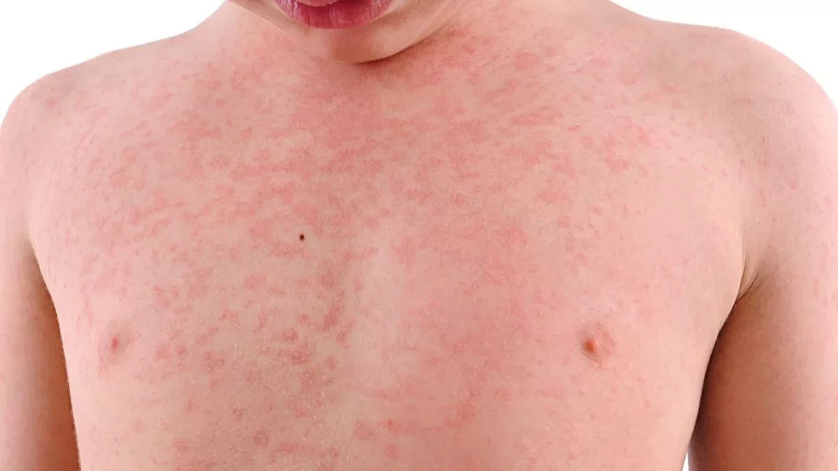 Measles cases soar in Europe in 2023: WHO