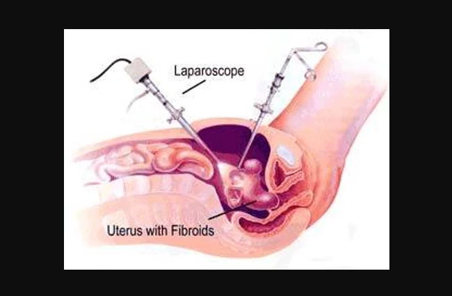 10 kg tumor mass removed from woman’s uterus in NW