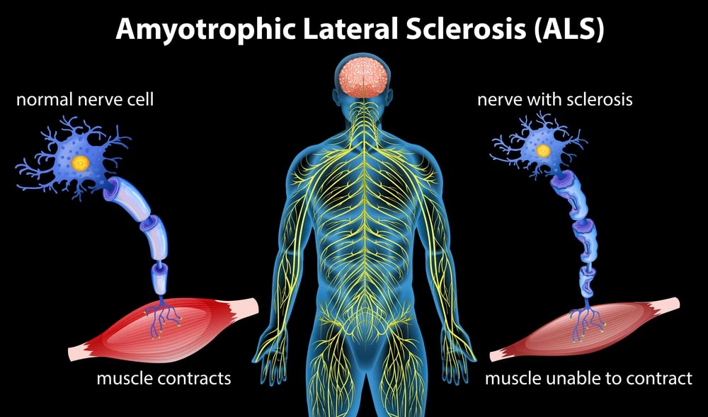 EU watchdog gives new ALS treatment thumbs up