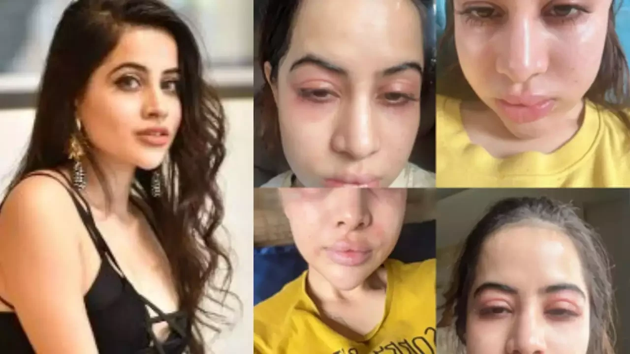 Allergies not fillers: Uorfi Javed reveals real story behind her swollen face