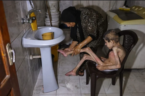 Dangerous skin diseases spreading among Gaza children