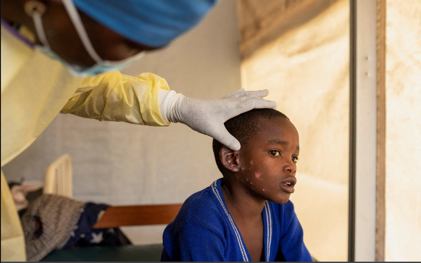 Mpox claims 548 lives in DR Congo since the start of 2024