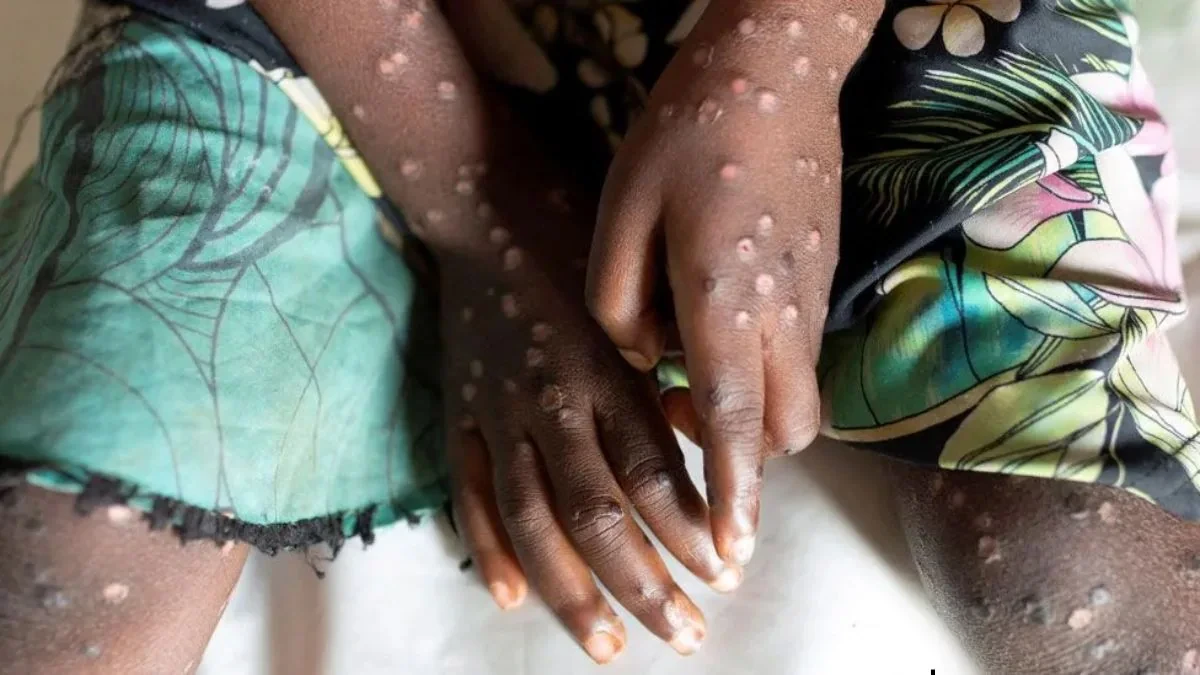 What we know about the new mpox outbreak